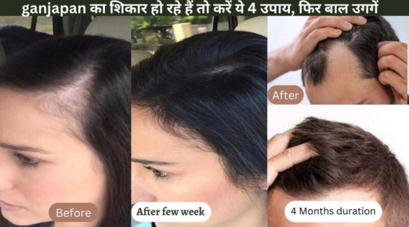 baldness in hindi